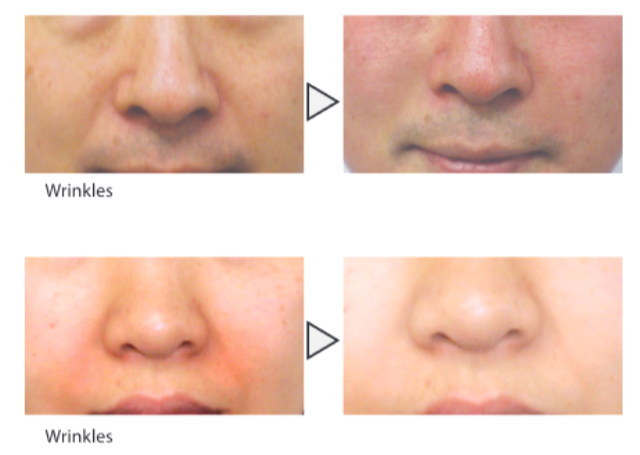 microneedling