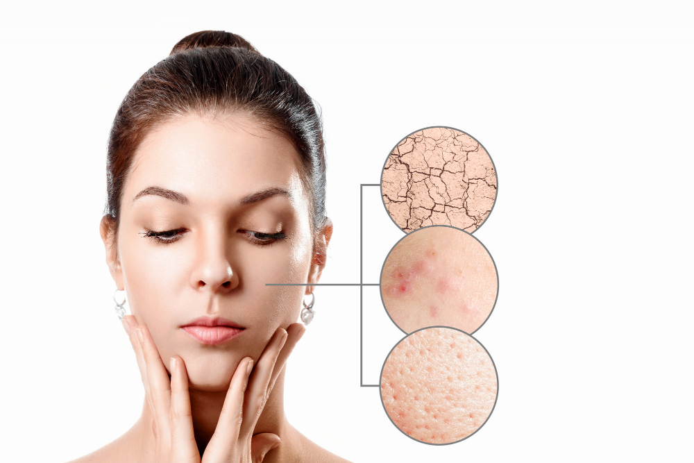 young woman with acne dry skin black dots skin zoom circle young girl beauty portrait close up