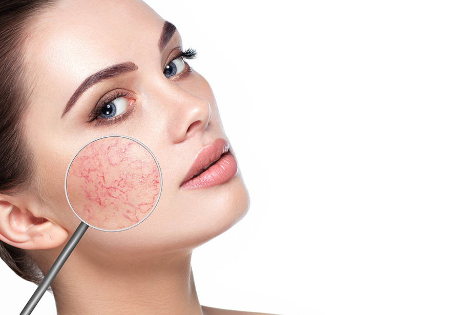 best vascular removal treatment in Dubai 1